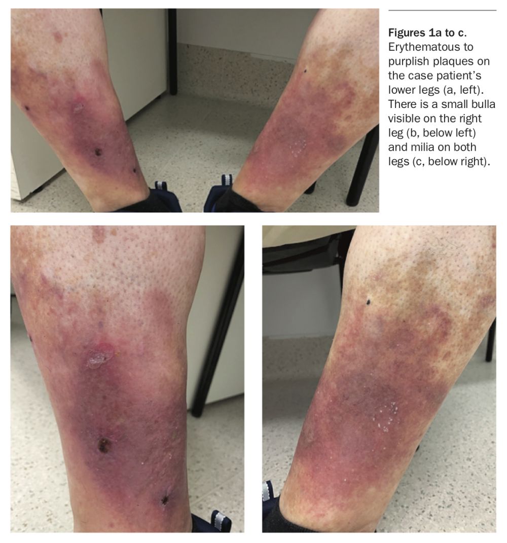 Bilateral erythematous plaques on the legs Medicine Today